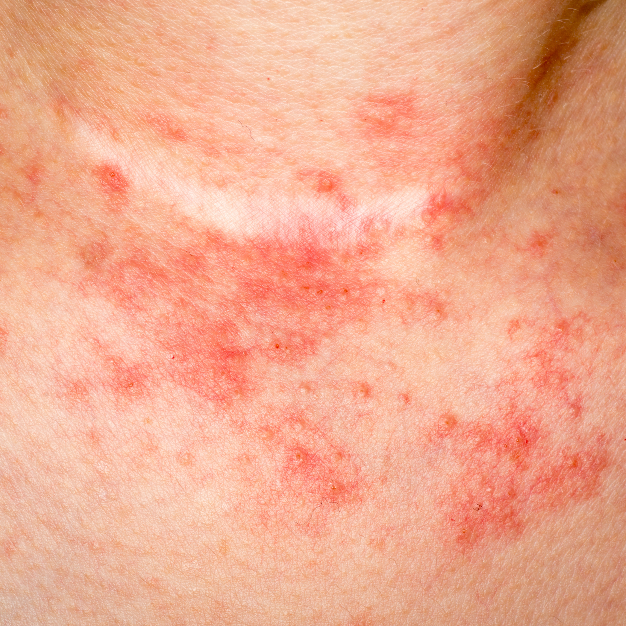 Can tallow help with acne, eczema or rosacea?